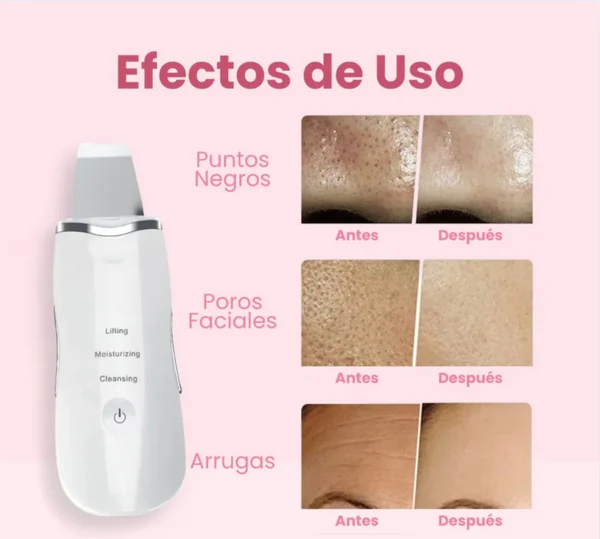 Limpiador Ultrasónico MultiPeel Power®